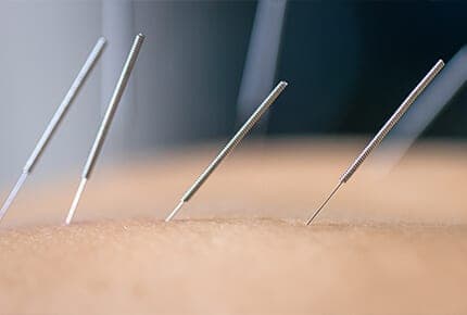 Acupuncture