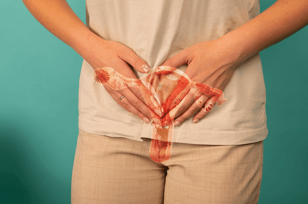 que es la endometriosis